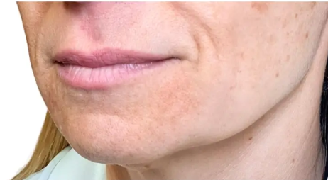 Preenchimento labial — antes