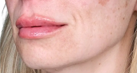 Preenchimento labial — depois
