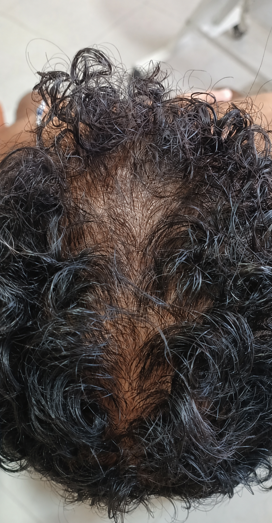 Tricologia — depois