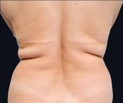 Intradermoterapia - Redução de medidas. — antes