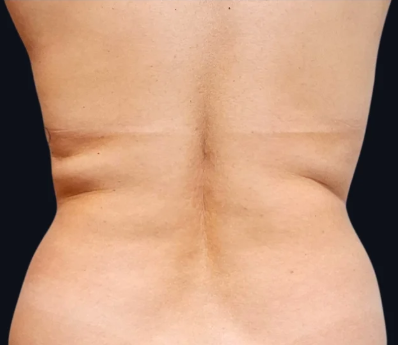 Intradermoterapia - Redução de medidas. — depois